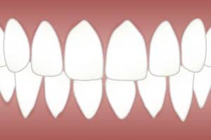 שיניים מושתלות