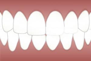 שיניים מושתלות
